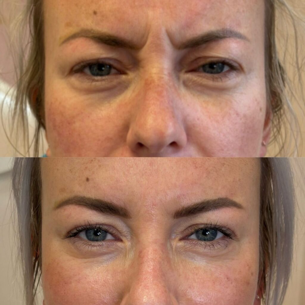 Anti Wrinkle Injections