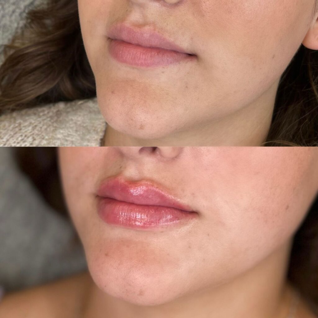 Dermal Fillers